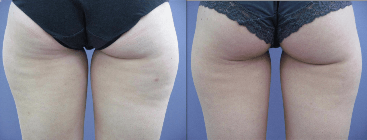 Imogen Currie RF Cellulite Straipsniai.lt