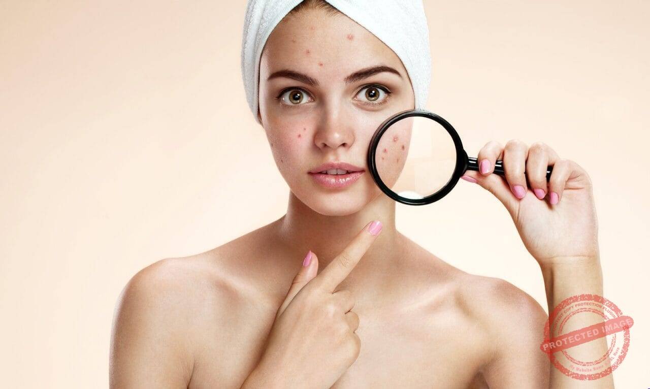 Bigstock Teen Girl With Problem Skin Lo